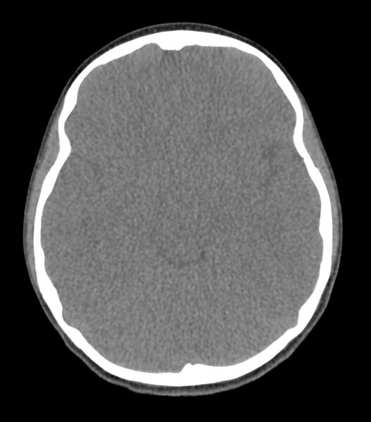 File:Nasoorbitoethmoid fracture (Radiopaedia 90044-107205 Axial non-contrast 200).jpg