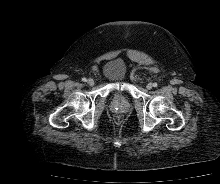 Nephroptosis with inguinal hernia containing perirenal fat (Radiopaedia 56632-63391 C 321).jpg