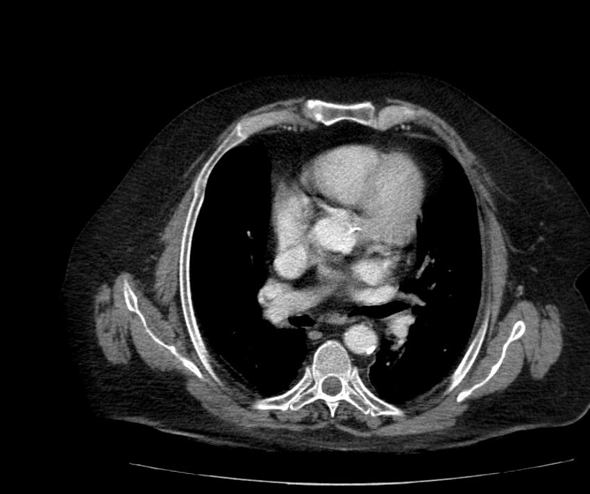Nephroptosis with inguinal hernia containing perirenal fat (Radiopaedia 56632-63391 C 9).jpg