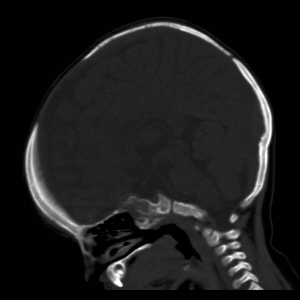 File:Neuroblastoma with skull metastases (Radiopaedia 30326-30958 Sagittal bone window 22).jpg