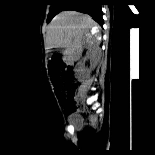 File:Neuroblastoma with skull metastases (Radiopaedia 30326-30960 B 14).jpg