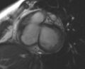 Non-compaction of the left ventricle (Radiopaedia 69436-79314 Short axis cine 165).jpg