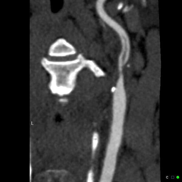 File:Non-occlusive intraluminal internal carotid artery thrombus (Radiopaedia 37751-39658 A 38).jpg