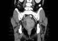 Non-puerperal uterine inversion (Radiopaedia 78343-91094 B 38).jpg