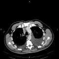 Non Hodgkin lymphoma in a patient with ankylosing spondylitis (Radiopaedia 84323-99621 B 12).jpg