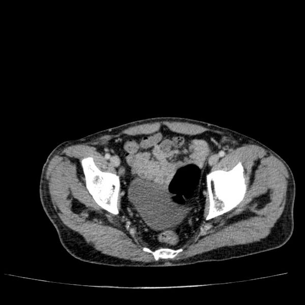 File:Non small-cell lung cancer (Radiopaedia 24467-24769 C+ delayed 109).jpg