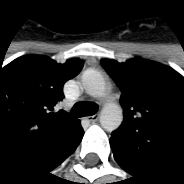 File:Normal CT of the neck (Radiopaedia 14575-14500 Axial C+ 79).jpg