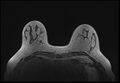 Normal breast MRI - dense breasts (Radiopaedia 80454-93850 Axial T1 65).jpg