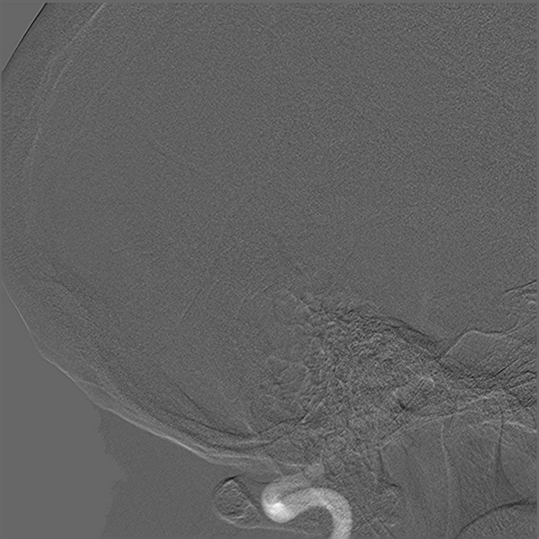 File:Normal cerebral angiogram (four vessel DSA) (Radiopaedia 41708-44649 R 7).png