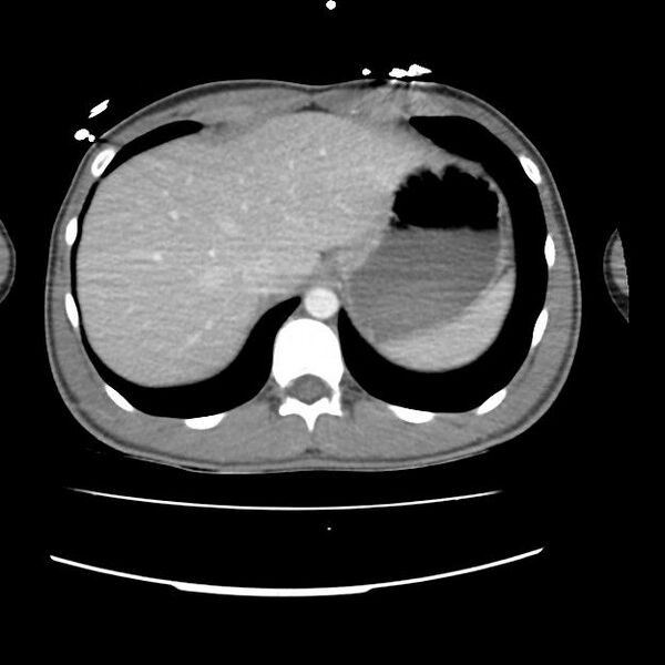 File:Normal dual-phase trauma CT chest,abdomen and pelvis (Radiopaedia 48092-52899 A 49).jpg