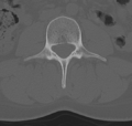 Normal lumbar spine CT (Radiopaedia 46533-50986 Axial bone window 36).png