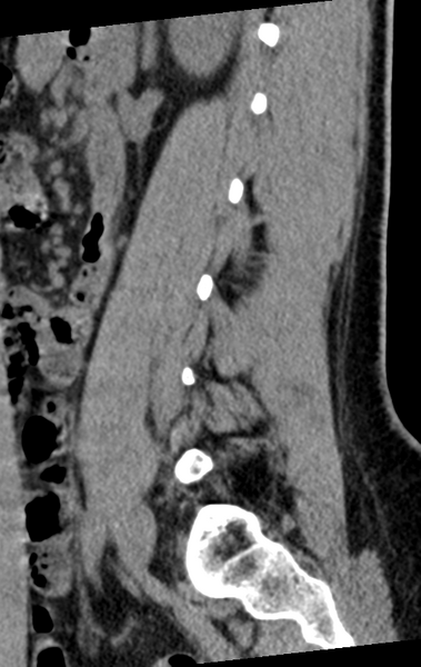 File:Normal lumbar spine CT (Radiopaedia 46533-50986 C 30).png
