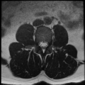 Normal lumbar spine MRI (Radiopaedia 35543-37039 Axial T2 25).png