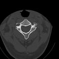 Occipital condyle fracture (Radiopaedia 31755-32691 Axial bone window 23).jpg