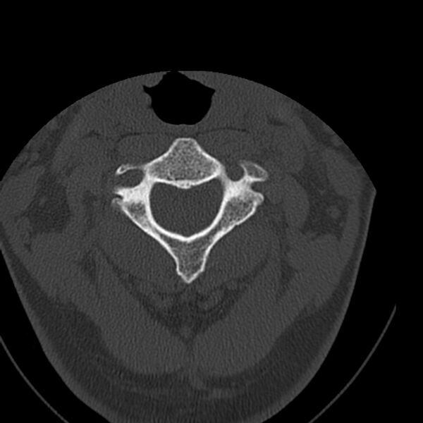 File:Occipital condyle fracture (Radiopaedia 31755-32691 Axial bone window 23).jpg