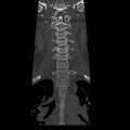 Occipital condyle fracture (Radiopaedia 31755-32691 Coronal bone window 10).jpg