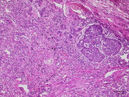 Lung adenocarcinoma with Lambert Eaton myasthenic syndrome-lesion shows proliferation of infiltrating atypical epithelial cells with cribriform or papillary structures