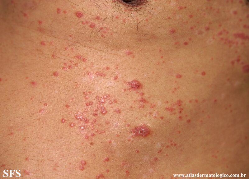 File:Psoriasis (Dermatology Atlas 120).jpg