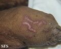Burrow in scabies