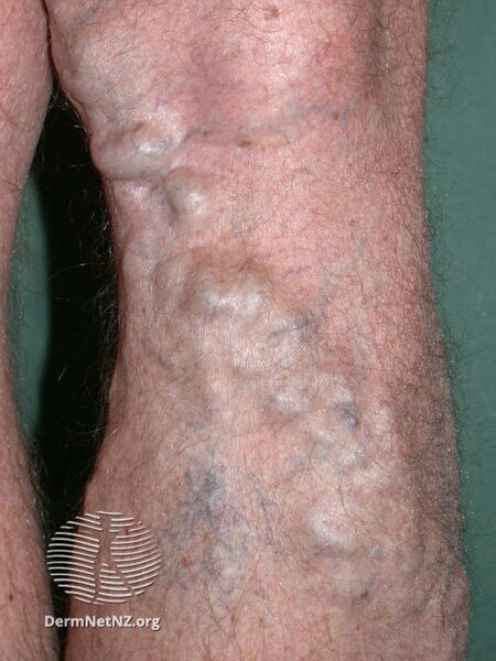 File:Varicose veins (DermNet NZ varicose-veins-02).jpg