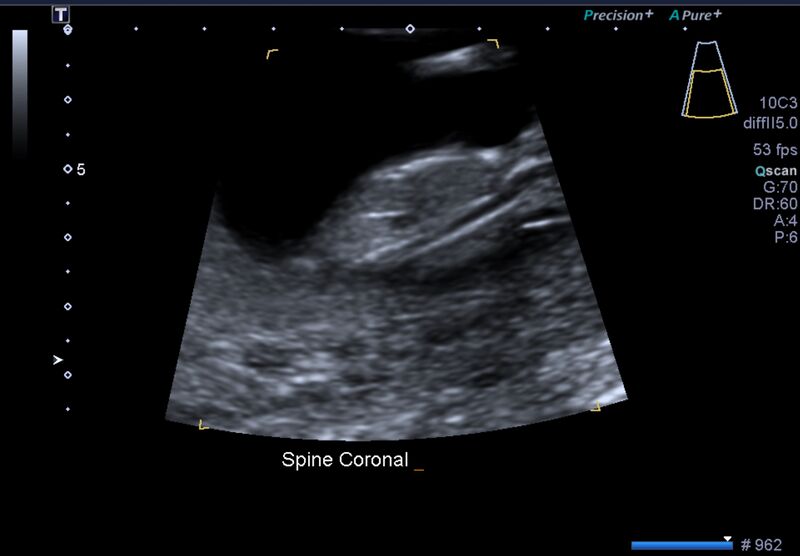 File:1st trimester nuchal-morphology ultrasound (Radiopaedia 44706-48477 General anatomy and NT 36).jpg
