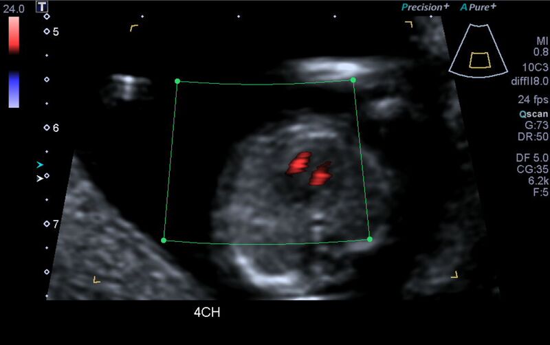 File:1st trimester nuchal-morphology ultrasound (Radiopaedia 44706-48477 Heart views cine with colour 8).jpg
