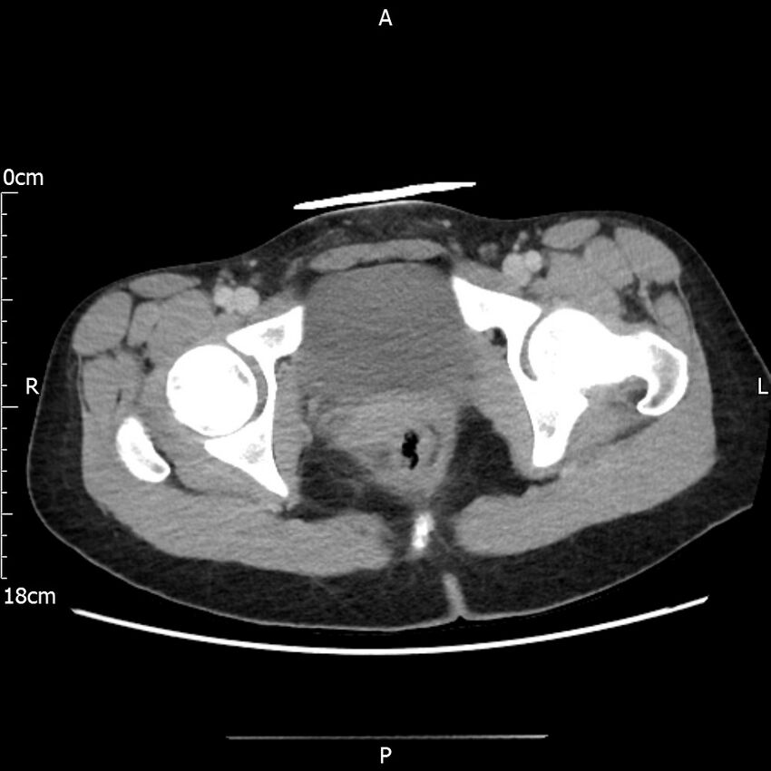 AAST grade IV kidney injury with CEUS follow-up (Radiopaedia 72353-82877 Axial C+ portal venous phase 76).jpg