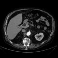 Abdominal aortic aneurysm (Radiopaedia 25855-26001 Axial C+ arterial phase 45).jpg