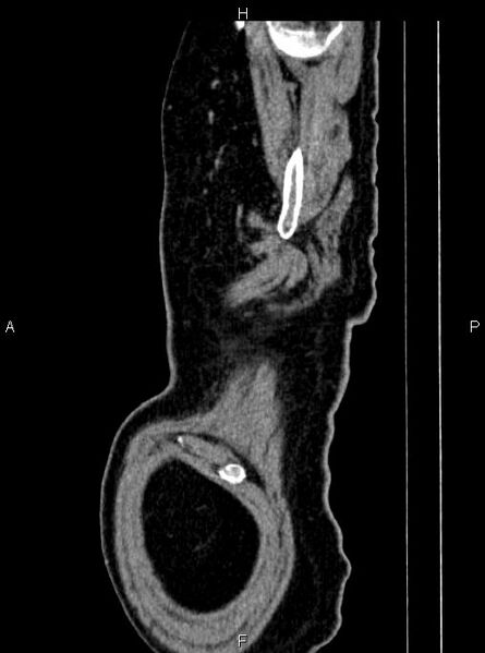 File:Abdominal aortic aneurysm (Radiopaedia 83094-97462 Sagittal renal cortical phase 8).jpg