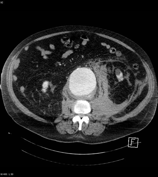 File:Abdominal aortic aneurysm with intramural hematoma then rupture (Radiopaedia 50278-55632 Axial C+ arterial phase 91).jpg