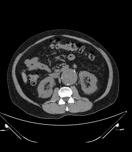 File:Abdominal aortic aneurysm with thrombus fissuration (Radiopaedia 46218-50618 Axial non-contrast 24).jpg