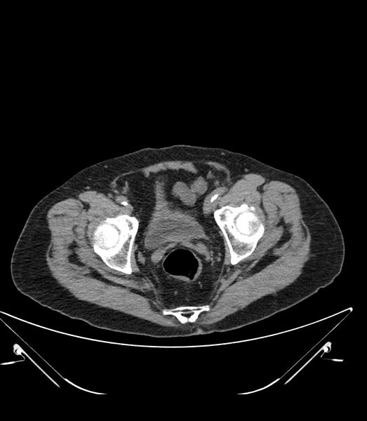 File:Abdominal aortic aneurysm with thrombus fissuration (Radiopaedia 46218-50618 Axial non-contrast 53).jpg