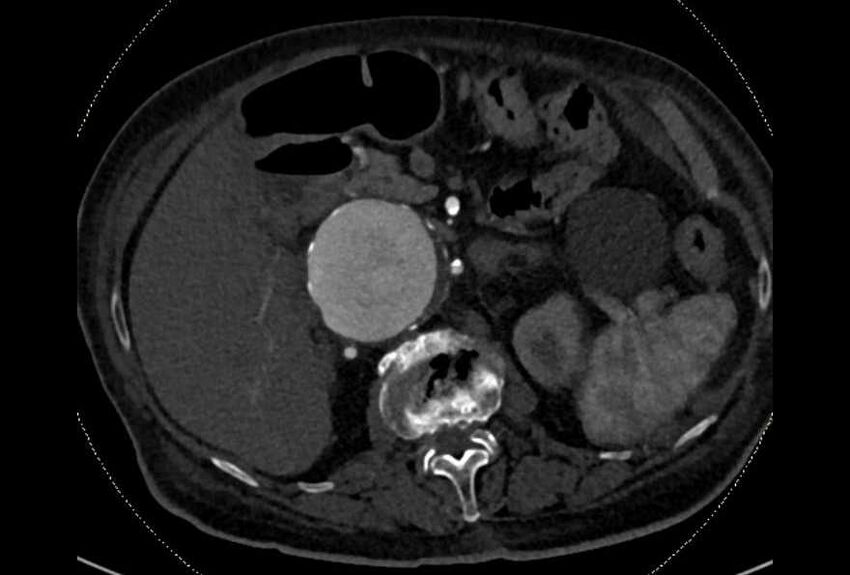 Abdominal aortic aneurysm with thrombus fissuration (Radiopaedia 73192-83919 Axial C+ arterial phase 48).jpg