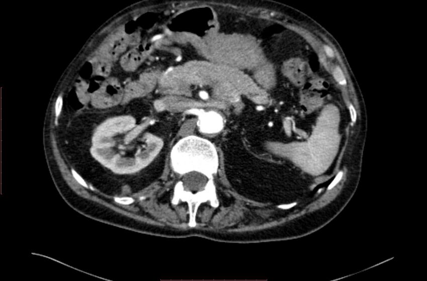 Abdominal aortic interposition tube graft and aneurysm thrombosis (Radiopaedia 71438-81857 Axial C+ arterial phase 32).jpg
