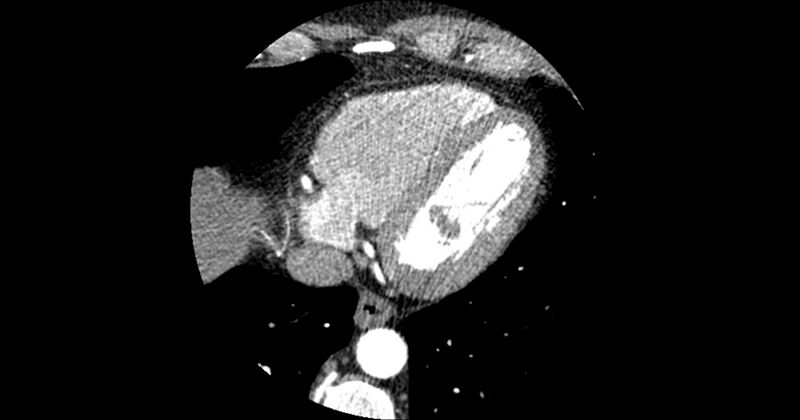 File:Aberrant left main coronary artery (ALMCA) arising from the right sinus with interarterial course (Radiopaedia 63251-71814 Axial C+ arterial phase 157).JPG
