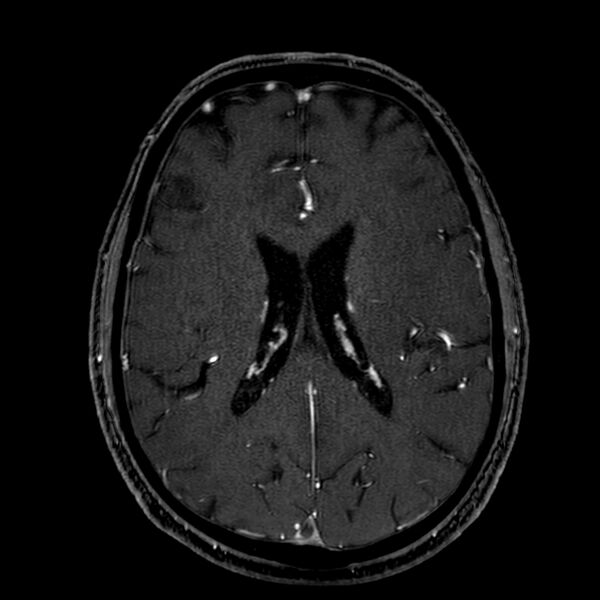 File:Accessory middle cerebral artery (Radiopaedia 73114-83828 Axial MRA 130).jpg