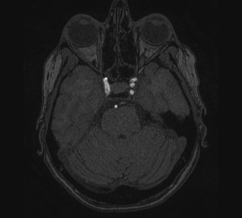 Accessory middle cerebral artery and ICA aneurysm (Radiopaedia 22656-22674 MRA 26).jpg