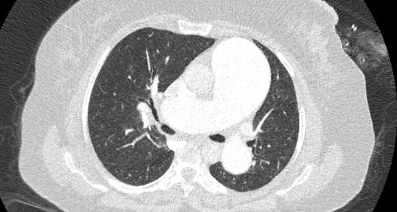 File:Accessory right inferior hepatic vein (Radiopaedia 65245-74259 Axial lung window 28).jpg