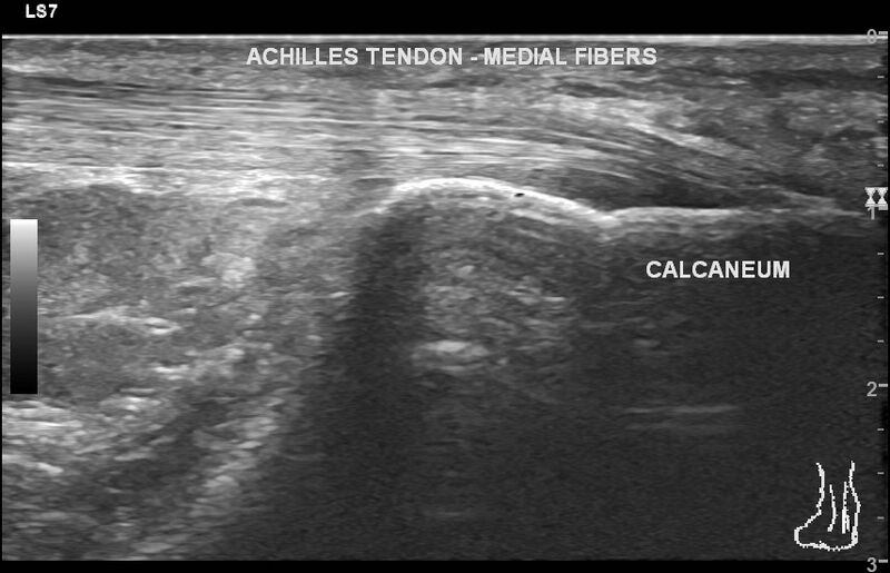 File:Achilles tendon laceration (Radiopaedia 85306).jpg