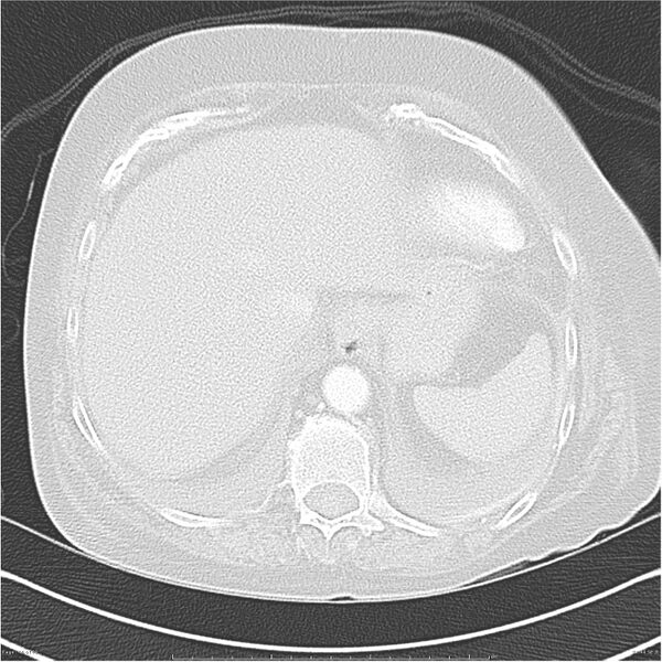 File:Acute-on-chronic pulmonary emboli (Radiopaedia 27925-28169 lung window 44).jpg