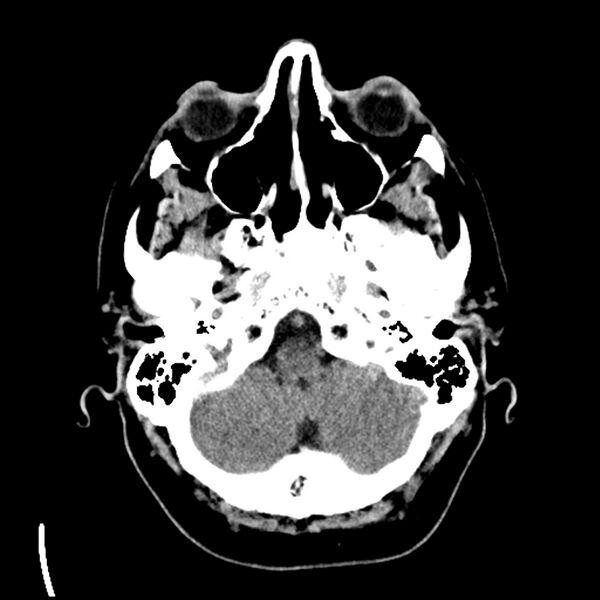 File:Acute A3 occlusion with ACA ischemic penumbra (CT perfusion) (Radiopaedia 72036-82525 Axial non-contrast 6).jpg