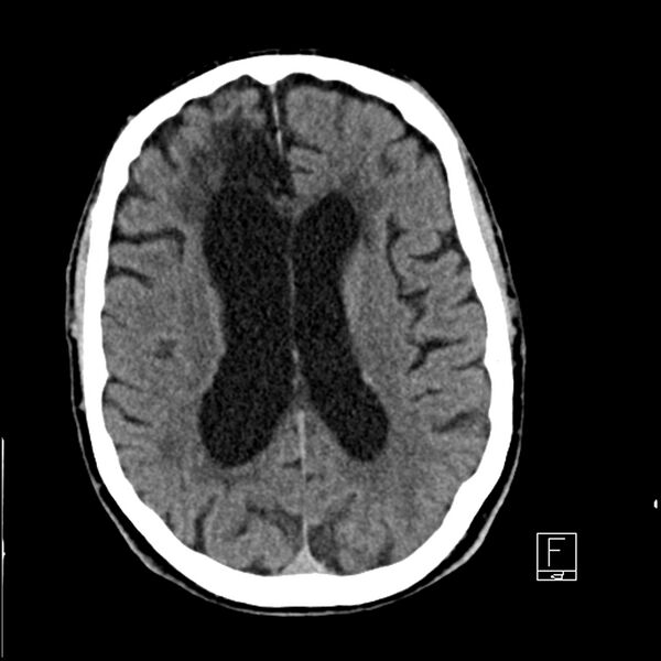 File:Acute ICA ischemic penumbra due to high-grade CCA stenosis (CT perfusion) (Radiopaedia 72038-82529 Axial non-contrast 28).jpg