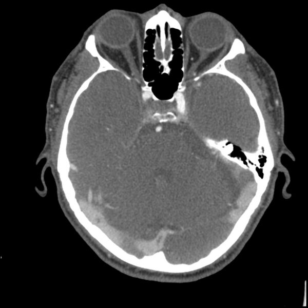 File:Acute P1 occlusion with PCA ischemia penumbra (CT perfusion) (Radiopaedia 72084-82587 Axial C+ arterial thins 66).jpg