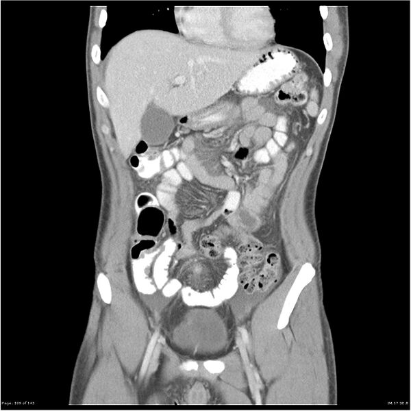 File:Acute appendicitis (Radiopaedia 25364-25615 C+ portal venous phase 6).jpg