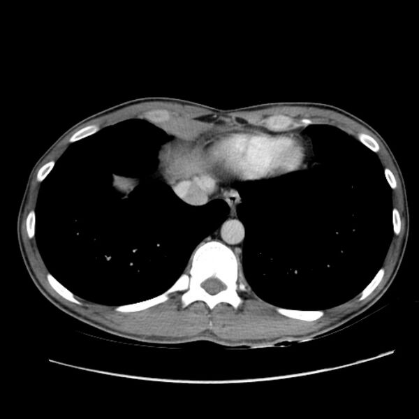 File:Acute appendicitis (Radiopaedia 27049-27227 Axial C+ portal venous phase 5).jpg