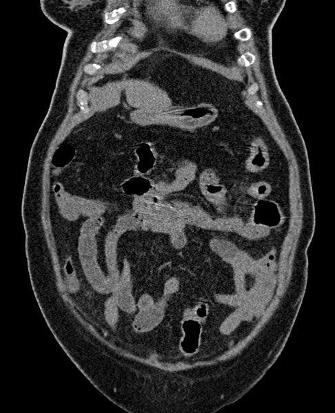 File:Acute appendicitis (Radiopaedia 58627-65818 Coronal non-contrast 27).jpg