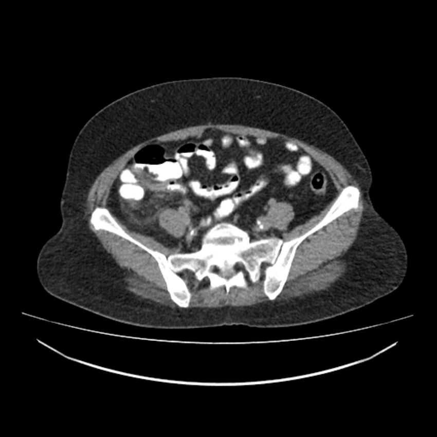 Acute appendicits - arrowhead sign (Radiopaedia 84254-99539 Axial C+ delayed 58).jpg