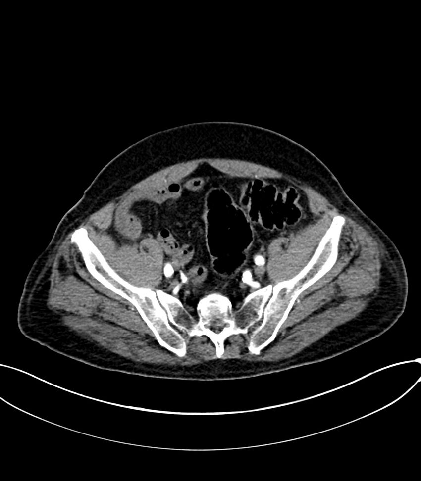 Acute arterial mesenteric ischemia (Radiopaedia 78238-90828 Axial C+ arterial phase 113).jpg
