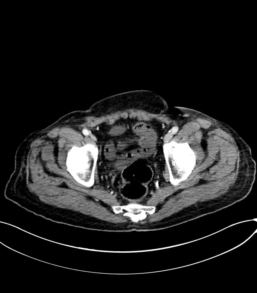 Acute arterial mesenteric ischemia (Radiopaedia 78238-90828 Axial C+ portal venous phase 127).jpg