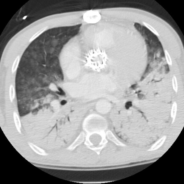 File:Acute diffuse alveolar hemorrhage (Radiopaedia 41323-44158 Axial lung window 34).jpg